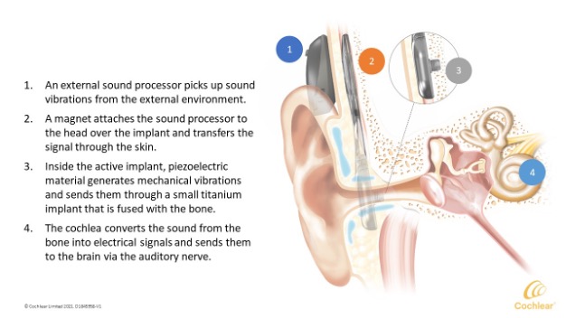 Cochlear diagram of bone-anchored hearing aids